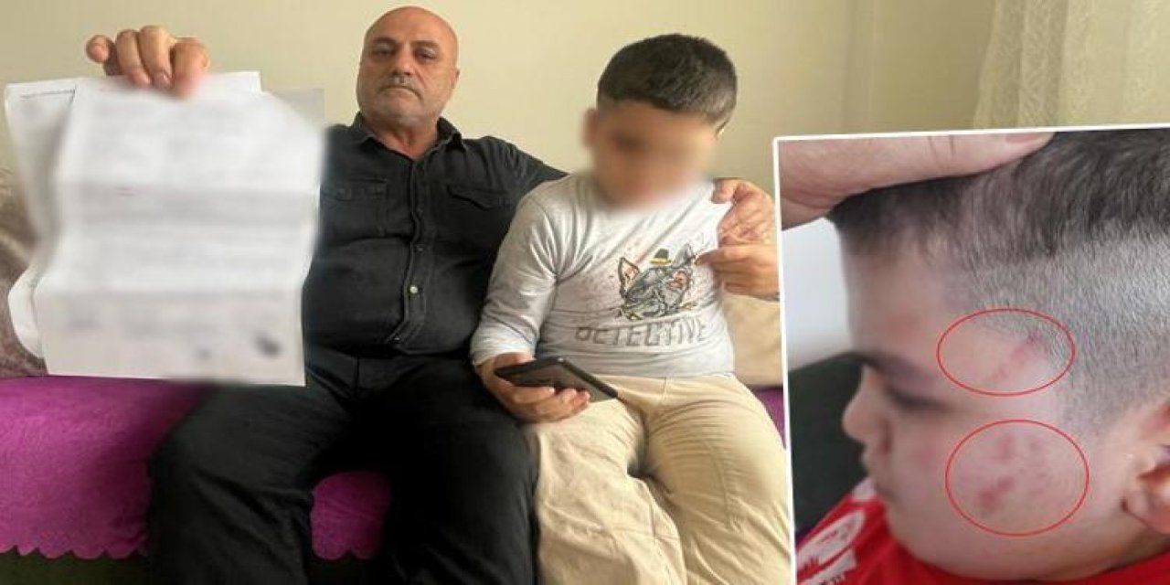 Otizmli öğrencinin vücudunda 54 morluk tespit edildi! Soruşturma başlatıldı, öğretmeni açığa alındı